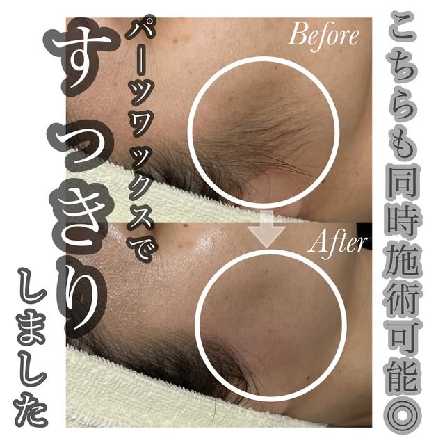 フェイシャルWAXのビフォーアフター